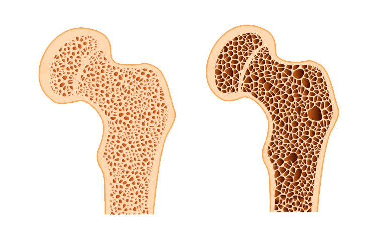 İnsülin Direnci ve Osteoporoz